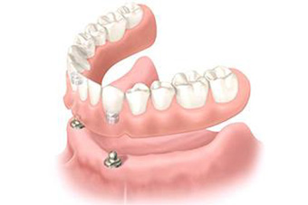歯茎への負担が少ない「インプラントオーバーデンチャー」